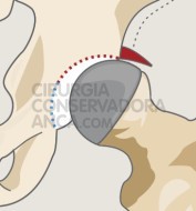 displasia-anca-fig.1-4