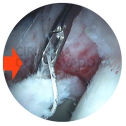 anca-infantil-artroscopia-fig.3