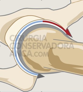 conflito-femuro-acetabular-que-&Atilde;&copy;-fig.1
