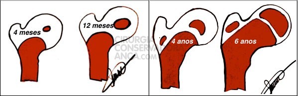 Desenvolvimento progressivo dos n&Atilde;&ordm;cleos de ossifica&Atilde;&sect;&Atilde;&pound;o do f&Atilde;&copy;mur proximal desde os 4 meses at&Atilde;&copy; aos 6 anos
