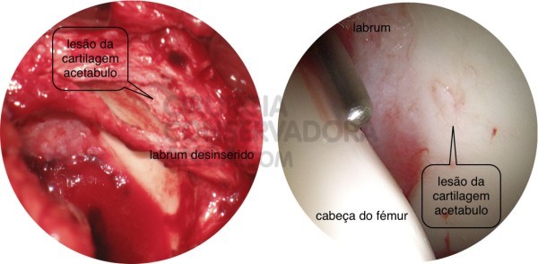 esquerda: les&Atilde;&pound;o grave da cartilagem direita: vis&Atilde;&pound;o artrosc&Atilde;&sup3;pica de uma les&Atilde;&pound;o da cartilagem acetabular