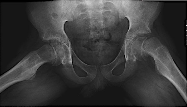 epifisiolise superior do f&Atilde;&copy;mur cr&Atilde;&sup3;nica bilateral numa crian&Atilde;&sect;a de 12 anos
