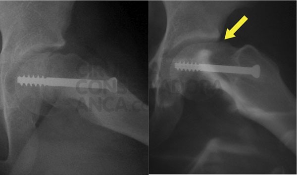 epifisiolise tratada com fixa&Atilde;&sect;&Atilde;&pound;o com uma parafuso