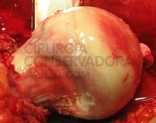 conflito-femuro-acetabular-solu&Atilde;&sect;&Atilde;&pound;o-fig.1
