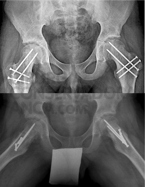 o mesmo caso da figura 4 ap&Atilde;&sup3;s reorienta&Atilde;&sect;&Atilde;&pound;o da epifise femoral.